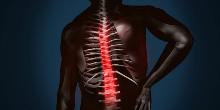 Lesiones espinales debido a la osteocondrosis.